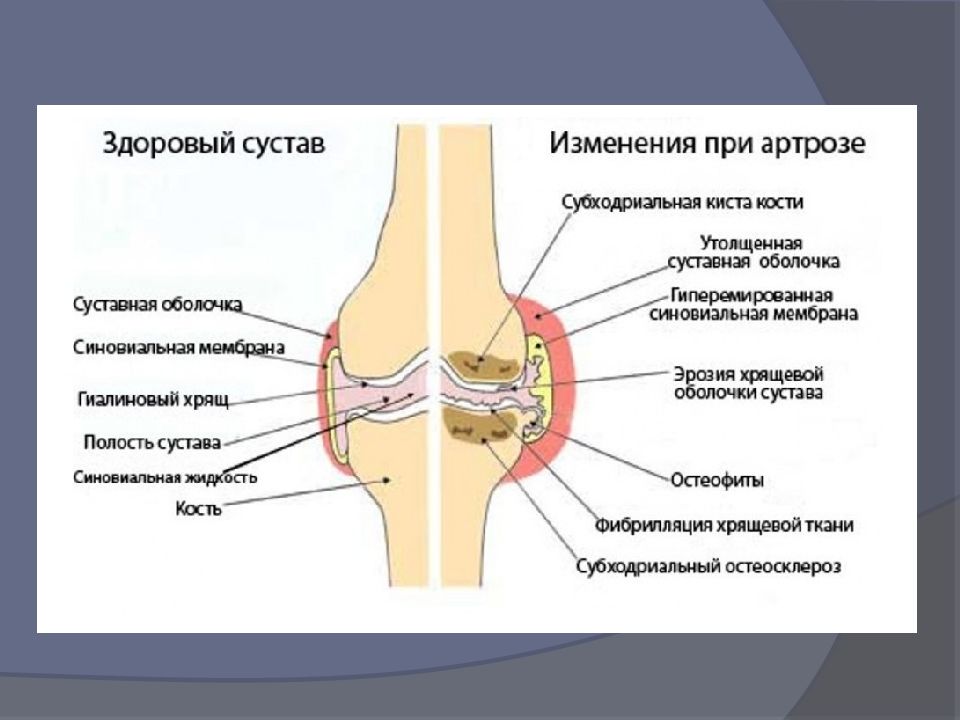 Артрит коленного сустава картинки