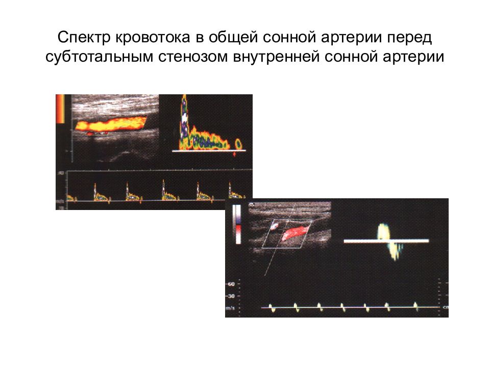 Скорость сонной артерии кровотока. Спектр кровотока общей сонной артерии. Допплерография, спектр кровотока. Спектр кровотока в позвоночной артерии. Спектр УЗИ общей сонной артерии.