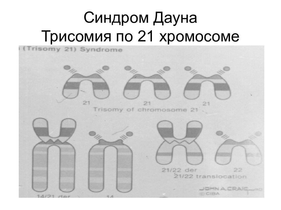 Синдром дауна механизм. Синдром Дауна хромосомы. Синдром Дауна 21 хромосома. Наследование синдрома Дауна схема. Набор хромосом у человека с синдромом Дауна.