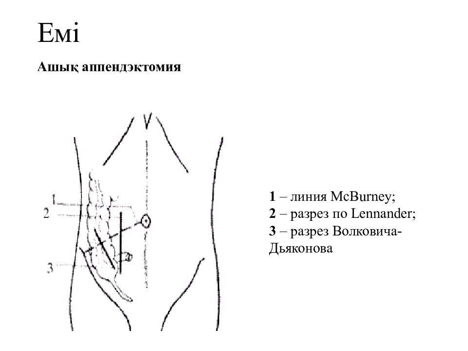 Симптом кохера волковича. Аппендэктомия по Волковичу Дьяконову Мак Бурнею.