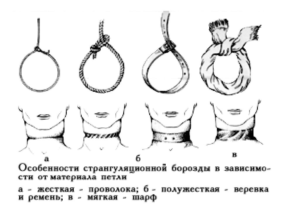 Механическая асфиксия картинки