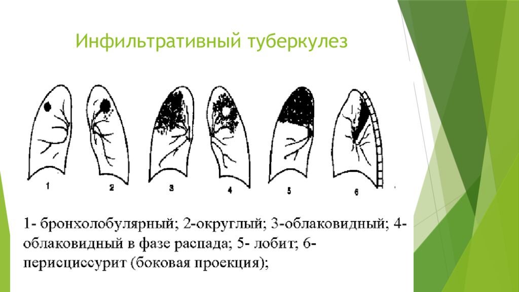 Инфильтративный туберкулез легких презентация