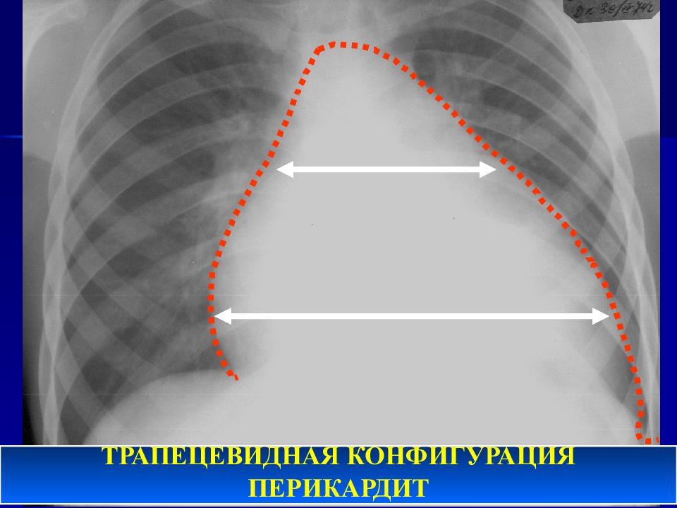 При выпотном перикардите на рентгенограмме наблюдается легочный рисунок тест ответ