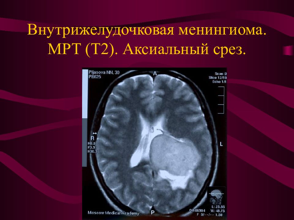 Опухоль головного мозга презентация