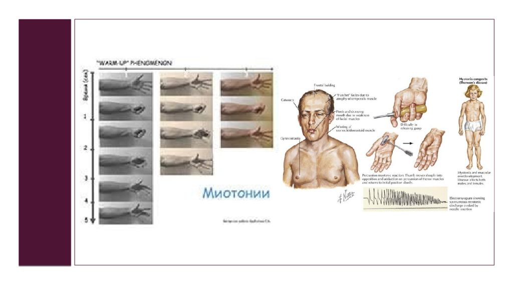 Миотония томпсона. Миотония Россолимо Штейнерта Куршмана. Болезнь Россолимо Штейнерта. Миотония Томсена Лейдена.