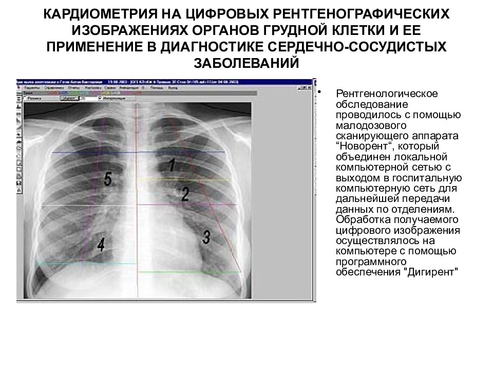 Исследование грудной клетки. Лучевые методы исследования органов грудной клетки. Методы исследования грудной клетки лучевая диагностика. Методы рентгенологического исследования органов грудной клетки. Виды лучевой диагностики заболеваний органов грудной клетки.