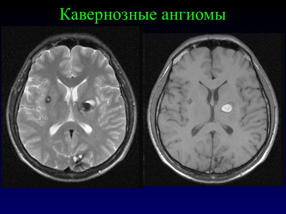 Ангиома мозга лечение