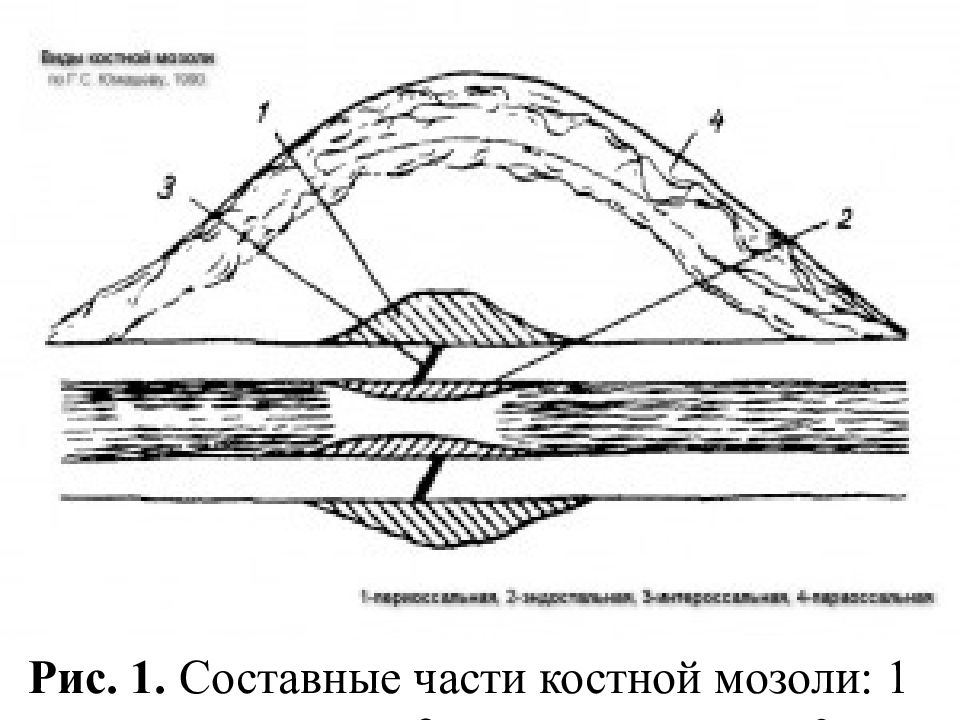 Костная мозоль это