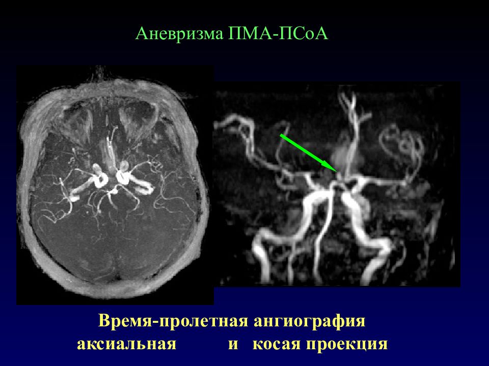 Сегмент а1 пма. Аневризма передней мозговой артерии кт. Аксиальная ангиография. Ангиография аневризма.