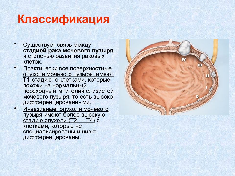 Схема cmv рака мочевого пузыря