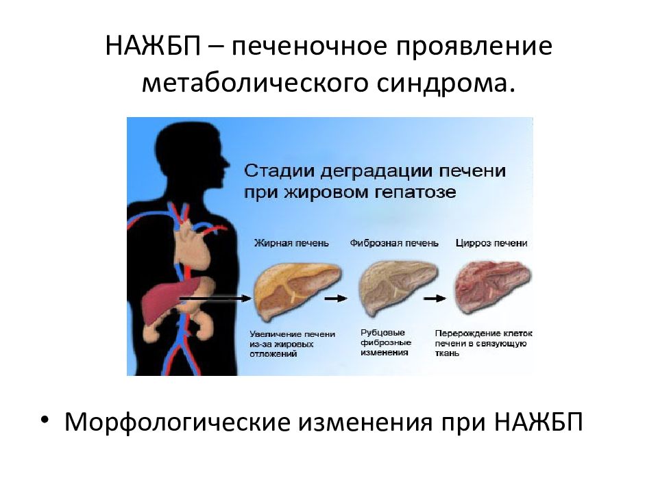 Лечение гепатоза печени. Метаболический синдром НАЖБП. Неалкогольная жировая болезнь печени (НАЖБП). Печень и метаболический синдром.