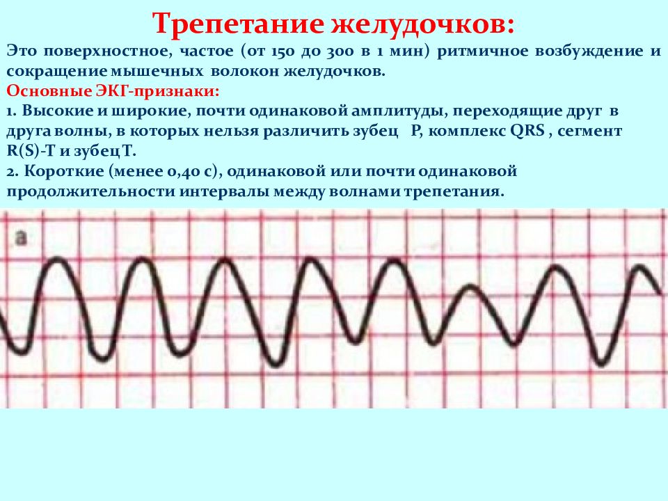 Экг при нарушениях ритма и проводимости презентация