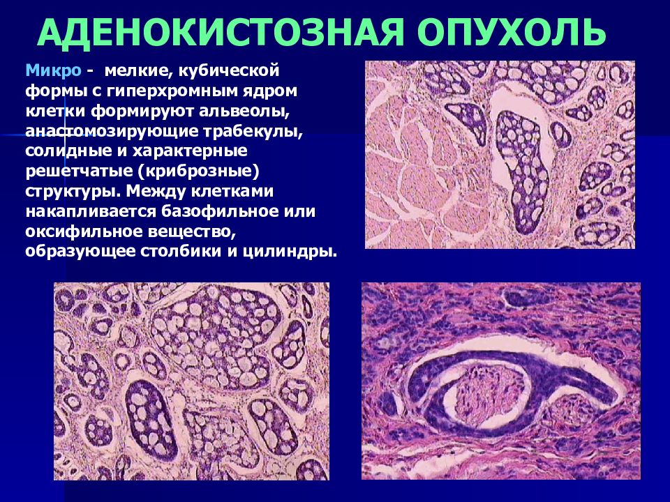 Солидное строение. Цилиндрома гистология. Аденокистозная опухоль. Аденокарцинома слюнных желез. Аденокистозная карцинома.