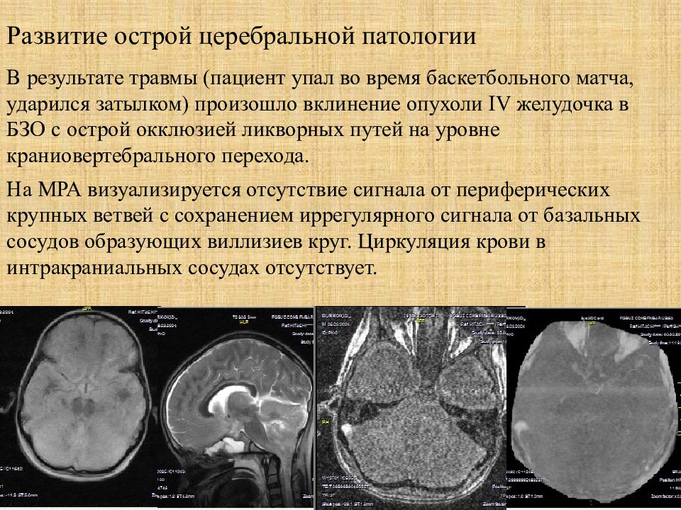 Диагноз опухоли головного