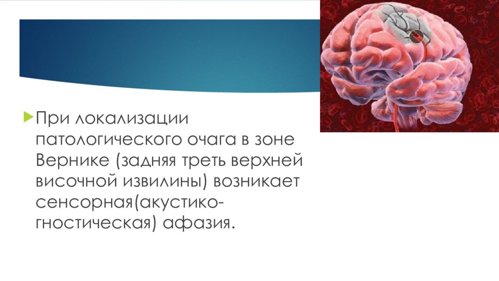 Афазия вернике. Сенсорная афазия зона Вернике. Сенсорная афазия развивается при поражении:. Сенсорная афазия локализация поражения. Сенсорная афазия очаг поражения.