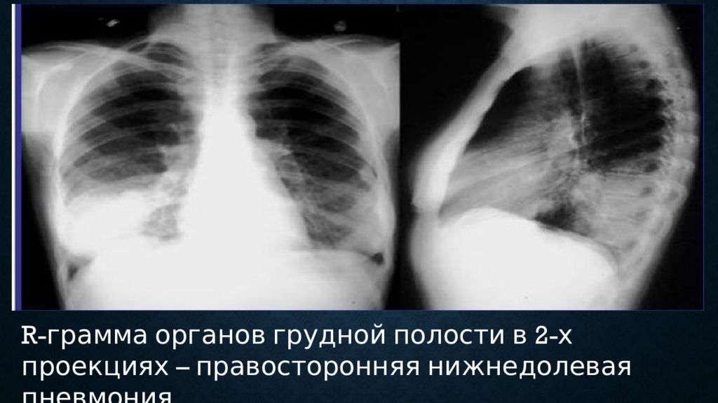 Пневмония в правом легком в нижней доле. Нижнедолевая очаговая пневмония рентген. Правосторонняя нижнедолевая крупозная пневмония рентген. Внебольничная нижнедолевая пневмония рентген. Правосторонняя нижнедолевая пневмония рентген.
