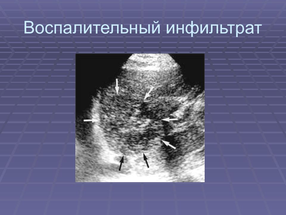 Инфильтрат это. Перипузырный инфильтрат. Абсцедирующий инфильтрат. Аппендикулярный инфильтрат на УЗИ. Инфильтрат мягких тканей на УЗИ.