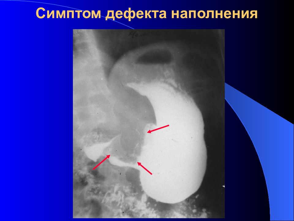 Признаки дефекта. Краевой дефект наполнения желудка рентген. Дефект наполнения желудка рентген. Дефект наполнения кишечника рентген. Симптом дефекта наполнения.