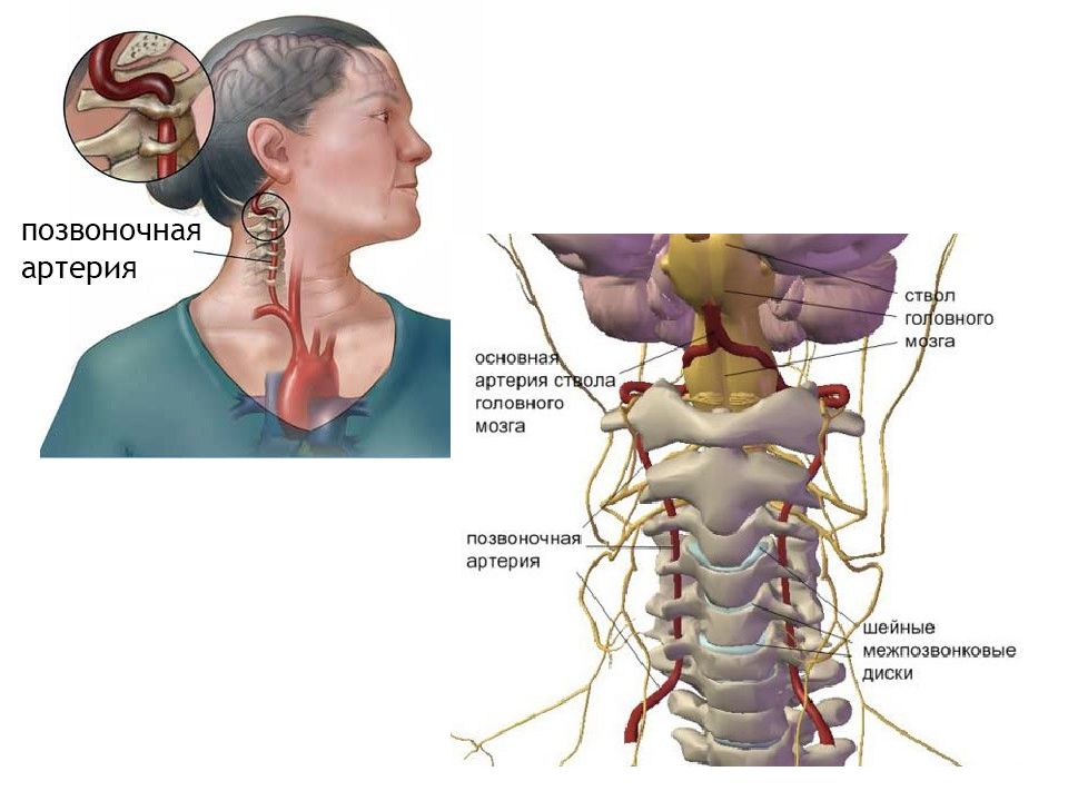 Позвоночные артерии картинки