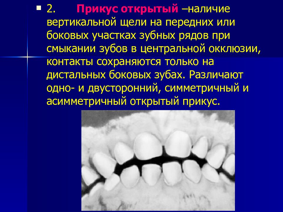 Открытый прикус. Открытый прикус в боковых участках. Вертикальная щель зубов. Открытый прикус степени.