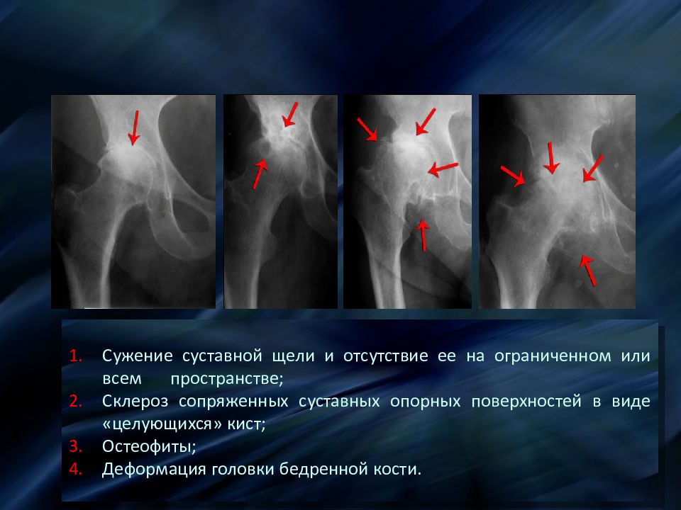 Склероз суставных поверхностей. Ширина рентгеновской суставной щели тазобедренного сустава. Суставная щель тазобедренного сустава норма. Умеренное сужение суставной щели. Сужение суставной щели тазобедренного сустава.