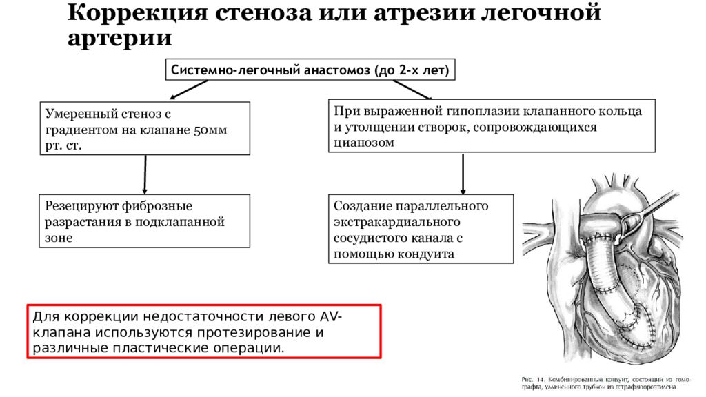 Стеноз легочной артерии. Стеноз легочного клапана аускультация. Атрезия легочной артерии. Стеноз и атрезия легочной артерии. ВПС атрезия легочной артерии.