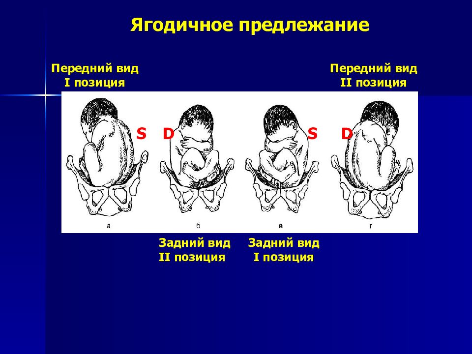 Тазовое предлежание презентация