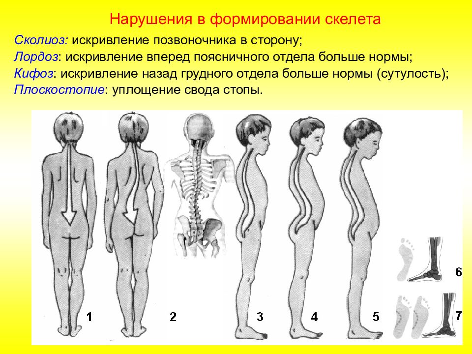 Сколиоз рисунок позвоночника