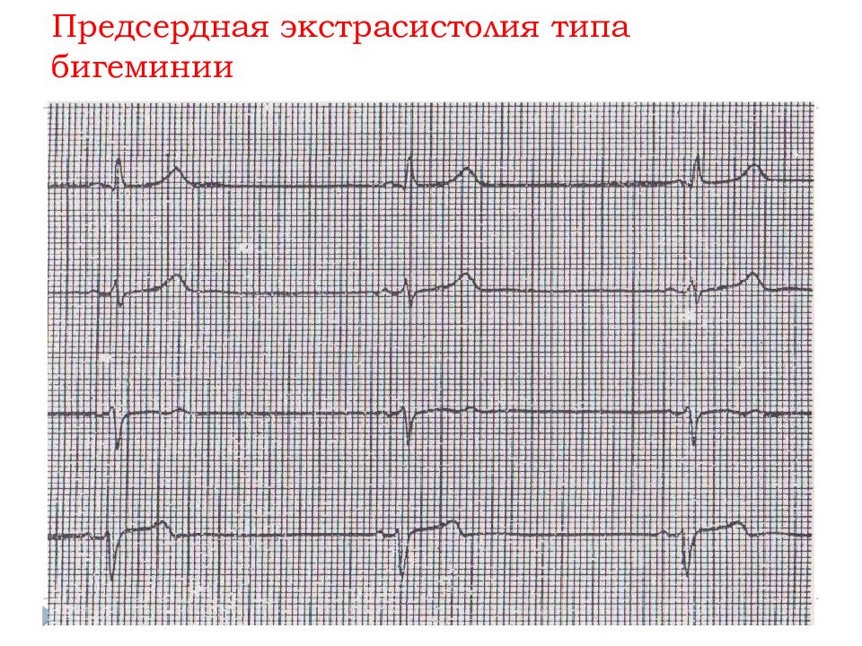 Предсердные экстрасистолы. Предсердная бигеминия на ЭКГ. Предсердная экстрасистолия на ЭКГ. ЭКГ блокированная экстрасистолия бигеминия. Предсердные экстрасистолы на ЭКГ.