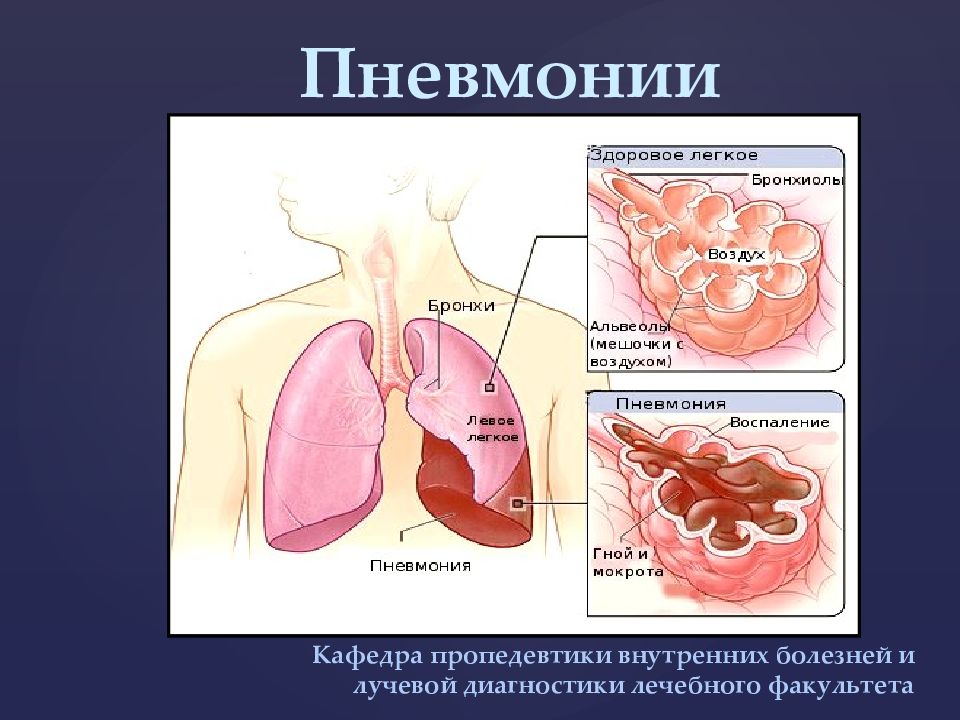 Пневмонии