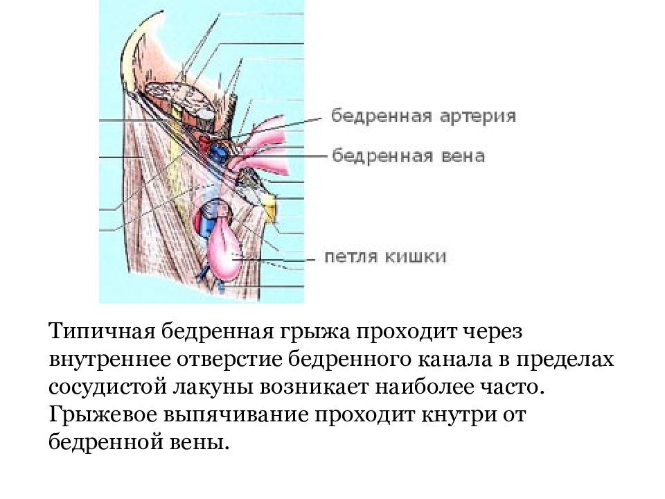 Бедренная щель. Топография бедренной грыжи. Бедренный канал схема топография. Бедренная грыжа сосудистая лакуна.