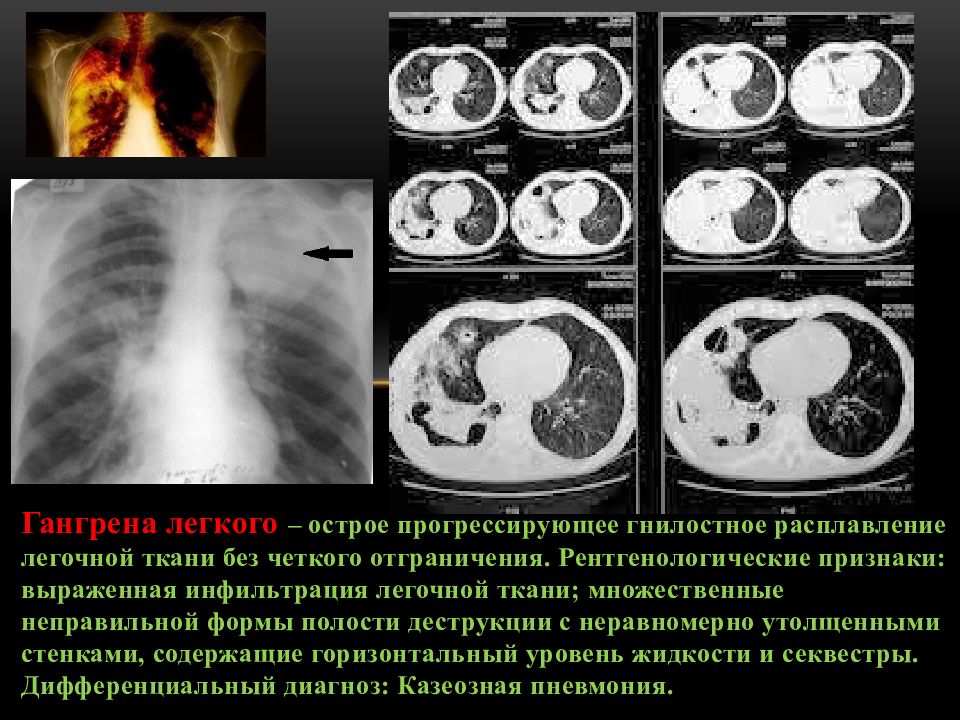 Гангрена легкого презентация