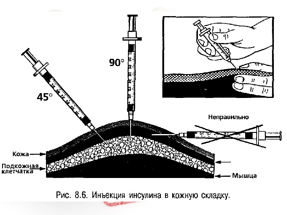 Подкожная инъекция алгоритм выполнения