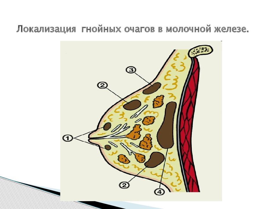 Мастит груди