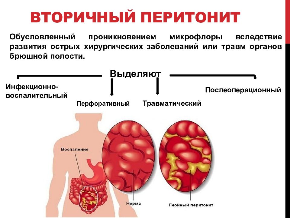 Как определить перитонит. Инфекционно воспалительный перитонит. Перитонит развивается при повреждении.