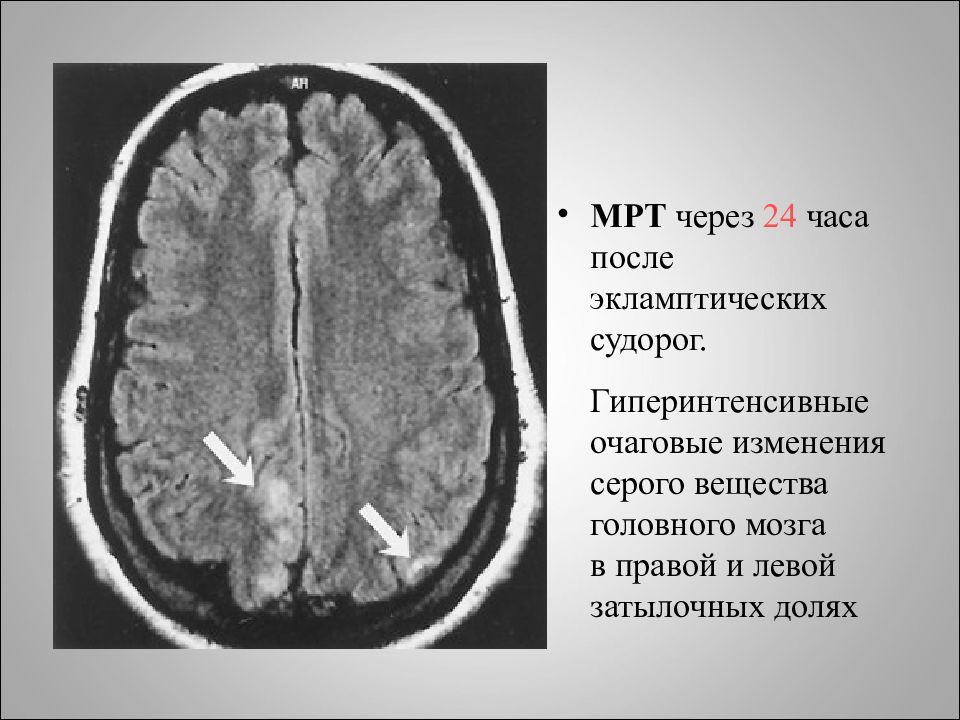 Мрт картина очаговых изменений вещества головного мозга дистрофического характера