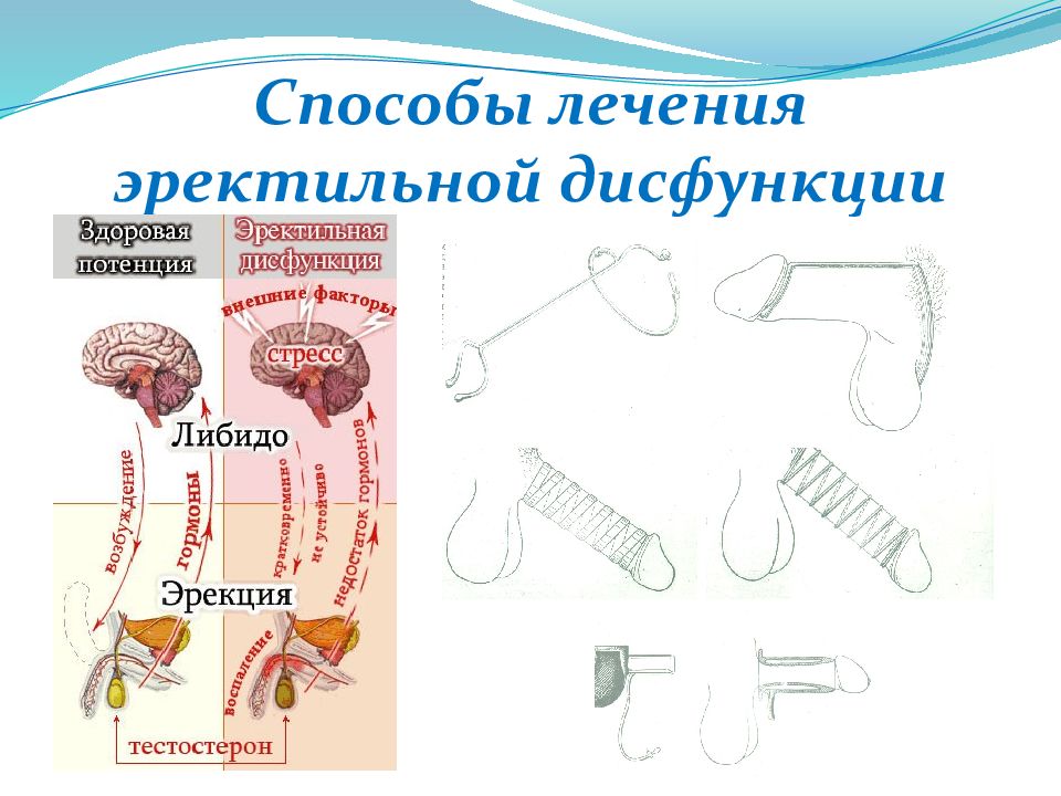 Эректильная дисфункция это. Лечение эректильной дисфункции. Эректильная дисфункция лечение. Лечение эректильной дисфункции у мужчин. Методы лечения эректильной дисфункции у мужчин.