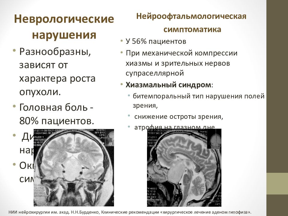 Картина микроаденомы гипофиза