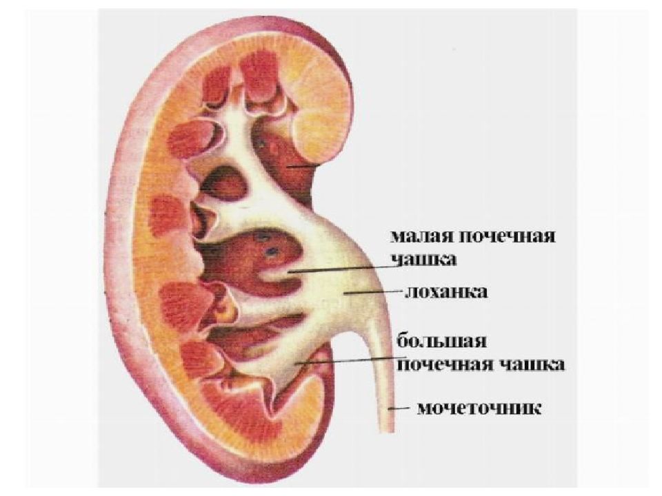 Чашечки почки. Мочекаменная болезнь камни в почках. Конкремент в чашечно-лоханочной системе. Локализация камней в поч.