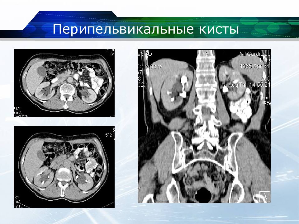 Парапельвикальные кисты почек