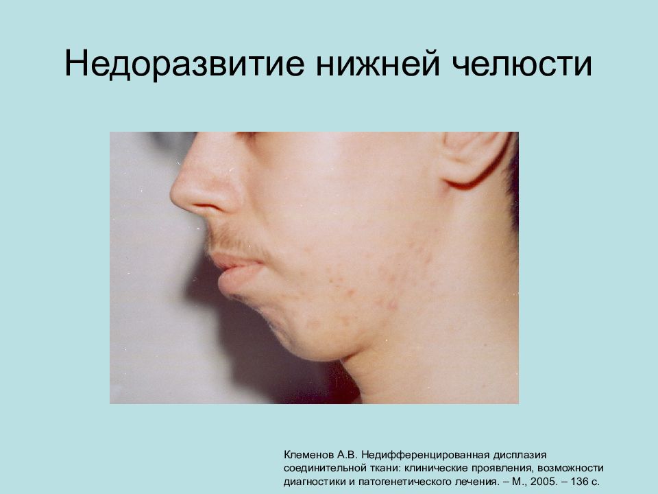 дисплазия соединительной ткани клинические рекомендации