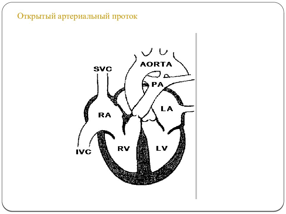 Шунт блелока-Тауссиг. Проба Вальсальвы легочный рисунок. Double Inlet left ventricle. Common Inlet right ventricle.