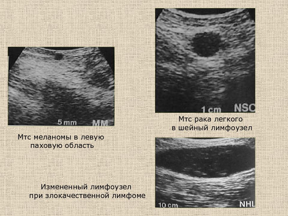 Лимфоузлы при раке легкого