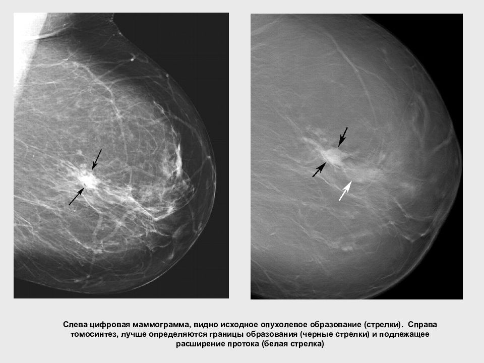 Узи лучше чем маммограмма. Рентгеновский томосинтез молочных желез. Томосинтез снимок молочных желез. Расширение протоков на маммограмме.
