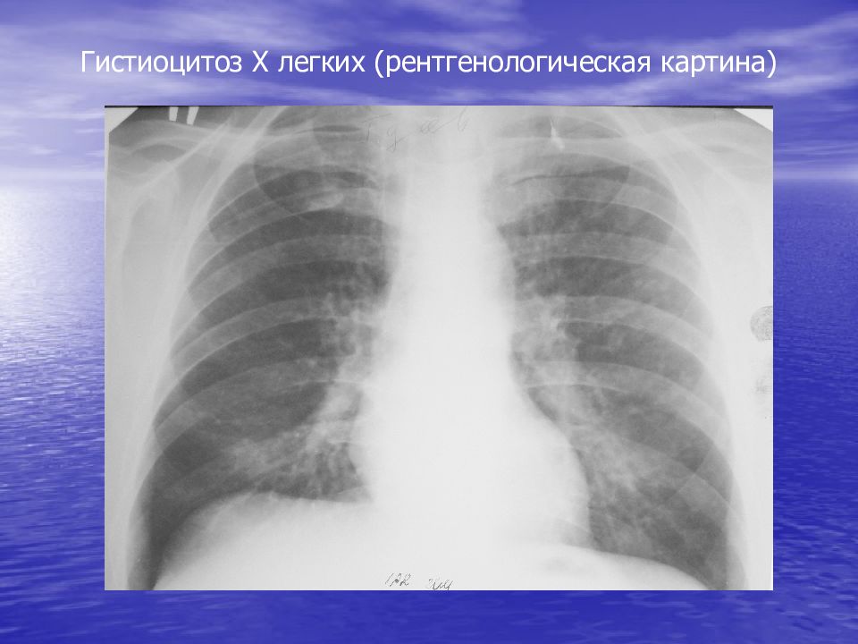 Легкий х. Гистиоцитоз х легких презентация. Рентгенологическая картина легких. Отёк лёгких рентгенологическая картина. Ушиб легкого рентгенологическая картина.