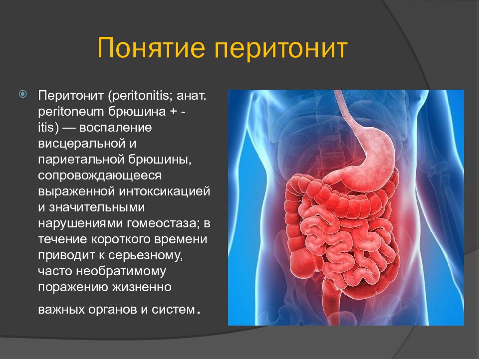 Перитонит причины развития перитонита. Воспаление париетальной брюшины. Разлитой каловый перитонит. Острый перитонит презентация.