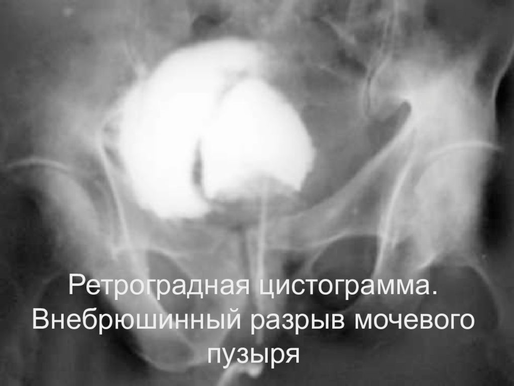 Операция на мочевом пузыре у мужчин. Цистография разрыв мочевого пузыря. Внутрибрюшинный разрыв мочевого пузыря рентген. Цистография при разрыве мочевого пузыря. Травма мочевого пузыря рентген.