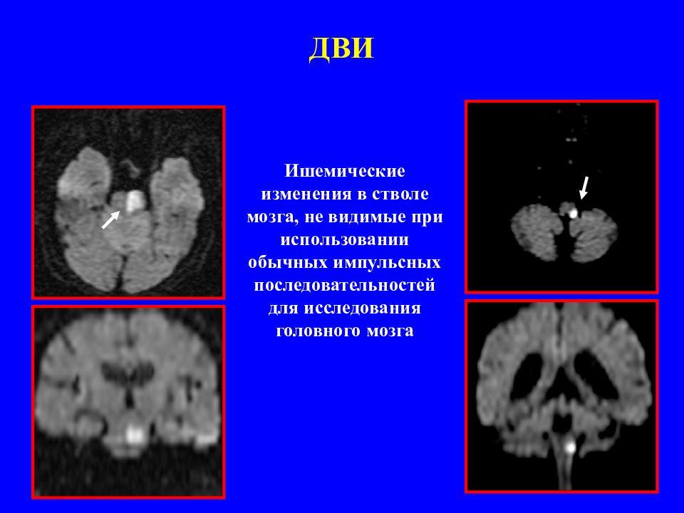 Дви что это. Т1 режим на мрт головного мозга. Режимы мрт головного мозга т1 т2. Дви мрт. Dwi режим мрт.