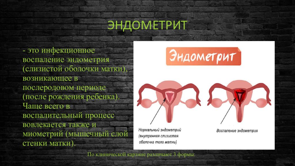 Послеродовые гнойно септические заболевания картинки