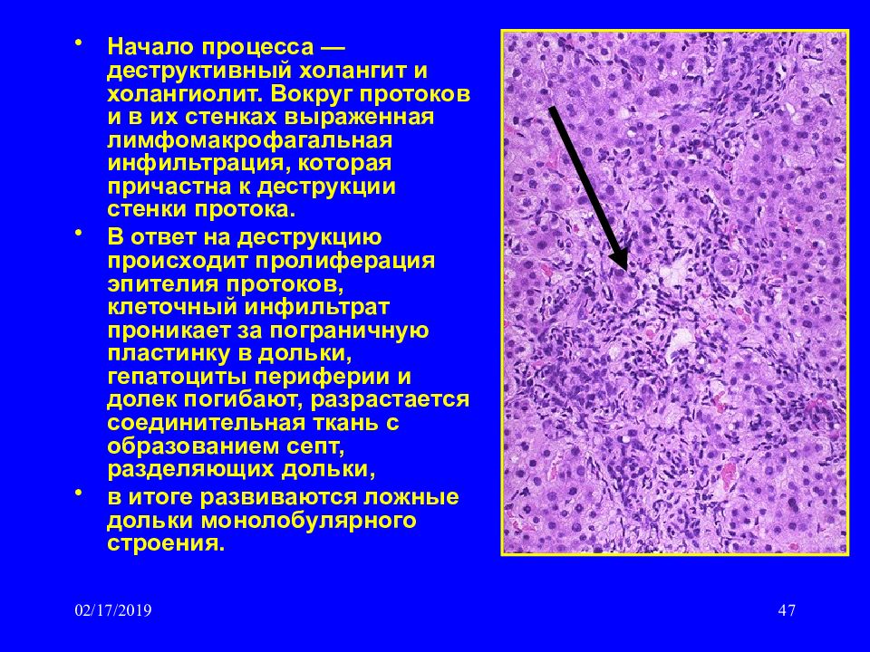 Пролиферация холангиол. Аденокарцинома поджелудочной гистология. Аденома желчных протоков печени гистология. Макрофагальная инфильтрация гистология.